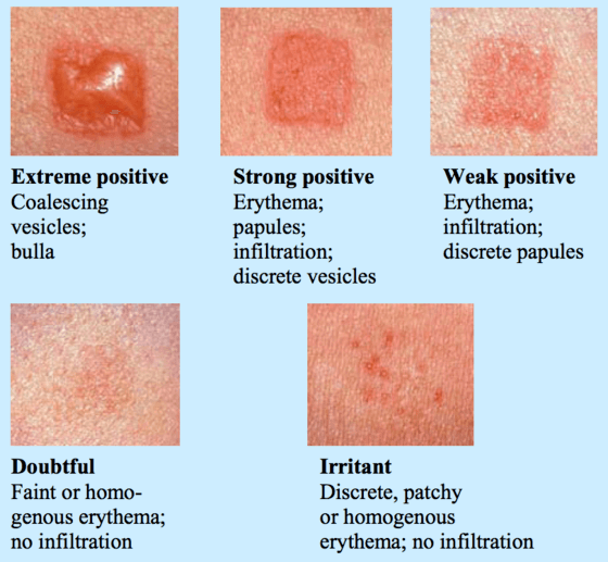 How To Read Allergy Test Results Pictures Photos