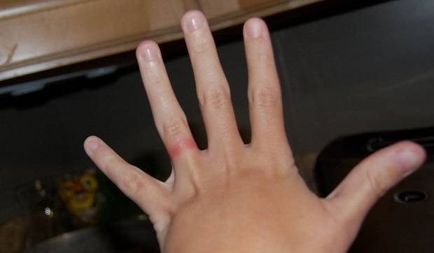 wedding ring dermatitis